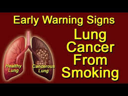 Most nonsmokers have no early signs of lung cancer, which means it is often not diagnosed until it has spread—but some do have symptoms in the early stages. Lung Cancer From Smoking Early Warning Signs Youtube