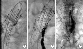 Classic dissection with true and false lumen. EndoprotezÄƒ Vs Chirurgie DeschisÄƒ In Tratamentul Anevrismelor Aortice Vascular Blog