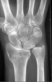 Wristwidget - Ulnar Impaction Syndrome (Uis) Also Has A... | Facebook