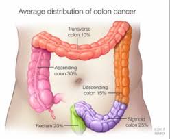 Colorectal cancer in this syndrome develops in about 38% of cases. Symptoms Facts Strides For Life Colon Cancer Foundation Burlingame Ca 650 692 3700