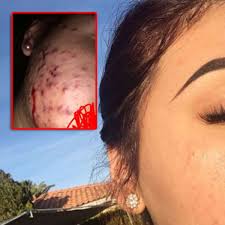 Deshalb gibt es hier vier tipps, die dabei helfen diese pickelmale zu entfernen und gleichzeitig unreiner haut. Unglaublich Junge Frau Heilt Akne Mit Nur Zwei Simplen Zutaten Gesundheit