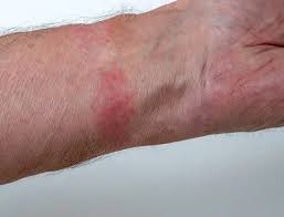 Image result for dermatitis contacta allergica