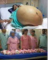 The heart is now fully formed and beats a whopping 180 times. Doctor Irfan Pregnant Woman Delivers 11 Babies In One Night Facebook