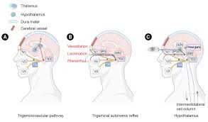 Image result for Cluster Headache