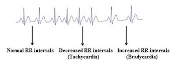 It is part of a university project for an incubator prototype, it has to activate some kind. Normal Ecg Vs Tachycardia And Bradycardia Download Scientific Diagram