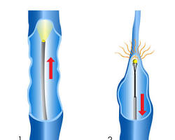 Image of Radiofrequency Ablation (RFA) for varicose veins
