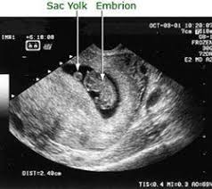 O ecografie tridimensionala poate furniza informatii suplimentare pentru a admira pe deplin fata. Sacul Yolk Semn De Sarcina La Prima Ecografie Copilul Ro