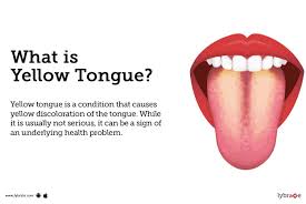 Image result for yellow tongue infection