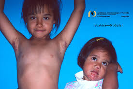 Image result for scabies human children