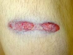 About cuts and grazes most cuts and grazes are minor and can be easily treated at home. Do You Need More Or Less Than 13 Stitches For A Grazed Bullet Wound On Your Arm Quora
