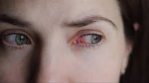 Red Itchy Eyes Coronavirus Or Allergies Dmei Dean Mcgee Eye Institute