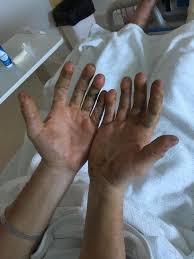 A finger infection caused by paronychia usually involves the tissue at the edges of the fingernail. Sepsis Induced Digital Ischaemia In A Professional Pianist In The Absence Of Vasopressors Bmj Case Reports