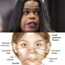Upslanting palpebral fissures, a suggestion of epicanthal folds, and a flat nasal bridge. Small Palpebral Fissures Railroad Track Ears Epicanthal Folds Low Nasal Bridge Flat Midface Upturned Nose Smooth Why You Do Not Drink When Pregnant Fetal Alcohol Syndrome Kim Foxx Pregnant Meme On