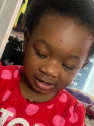 What remedies can help dry out hands foot and mouth disease bumps?