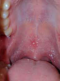 Therefore, this is something that can easily be small bumps in the mouth are caused by many things. Bump Appears In My Mouth Every Time I Drink Root Beer Wtf