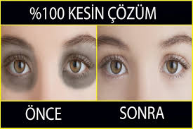 Gozalti Morluklari Tedavisi Guzellik Gozler Cilt Beyazlatma