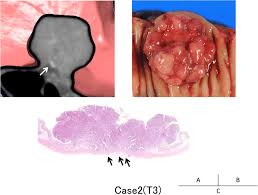 Age standardized (world) incidence rates, colon, females, all ages. A 72 Year Old Male With T3 Sigmoid Colon Cancer A Mpr Images Revealed Download Scientific Diagram