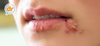 Herpes simplex virus is common in the united states. Tanda Dan Gejala Herpes Type 1 Hsv Dokter Indonesia