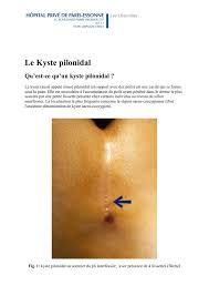 Kyste contenant des débris de cheveux et de peau près ou sur la fente des kyste thyroglossal: Kyste Pilonidal Le Kyste Pilonidal