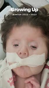 If you’ve been following for a while now, you’ve experienced all the ups  and downs we’ve been thru. Here’s a bit of a flashback of the journey,  struggle, and all the love this little guy has brought ...