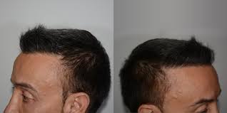 La tecnica fue (follicular unit extraction) è una modalità di trapianto dei capelli che si basa sull'espianto diretto, . Dr Vincenzo Gambino I Autotrapianto I Innesto Capelli I Fue