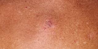 What patients and caregivers need to know about cancer, coronavirus, and c. Melanoma In Situ Skin Cancer And Reconstructive Surgery Center