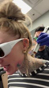 Removery: Efectivo Borrado de Tatuajes