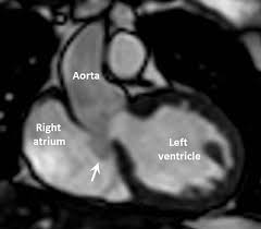 Aneurysm Of Sinus Of Valsalva Wikiwand An aortic aneurysm is an abnormal enlargement or bulging of the wall of the aorta.