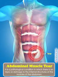 Muscles in lower left abdomen. Abdominal Muscle Tear Causes Symptoms Treatment Recovery Exercise