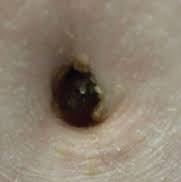Image result for Umbilicus