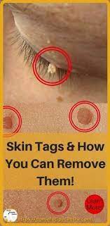 Skin Tag Removal With Easy Home Remedies Find Out How Here Skintags Skin Tag Skin Tag Removal Skin Tag On Eyelid