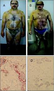 Image result for Anhidrosis