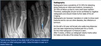 Bone, like most tissue in the body usually, it will hurt to press on it, and the pain will get progressively worse as you run on it, eventually hurting while walking or even when you're not. Leg And Foot Stress Fractures Physiopedia