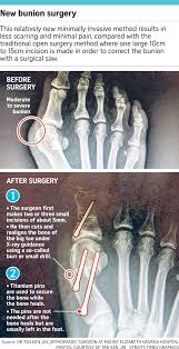 Fixing That Bunion Problem Can Be A Snip If Done Early Singapore News Top Stories The Straits Times Bunion Surgery Bunion Get Rid Of Bunions