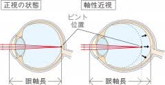 アトロピン0 01 点眼薬 マイオピン 近視進行抑制 富久クロス眼科