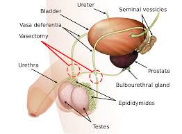 Copy of ttaaa male anatomy diagram labeling labelled diagram. Vasectomy Wikipedia