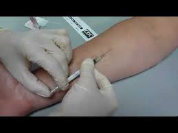 Ppd test negatifleşmesi türkiyede ancak hücresel immünütenin baskılandığı durumlarda gözlenir. How To Place Ppd