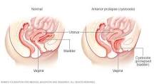 Image result for icd 10 code for pelvic floor prolapse