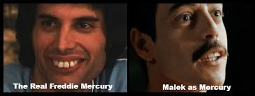 In bohemian rhapsody, the new queen biopic, mercury finds roger taylor and brian may. Would Invisalign Have Been An Option For Freddie Mercury Steve Sirin Dds