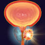 "Cáncer de próstata" "inteligencia artificial" IA de www1.hospitalitaliano.org.ar
