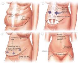 U Can Expect To Have A Horizontal Scar Below Your Panty Line And A U Shaped Scar Around Your Belly Tummy Tuck Surgery Tummy Tucks Recovery Mini Tummy Tuck