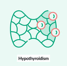 Graves' disease is a type of hyperthyroidism that is due to the production of autoantibodies against the tsh receptor on the follicular epithelial cells. Hypothyroidism Amboss
