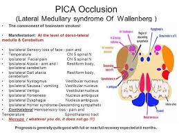 Image result for Posterior Circulation