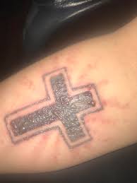 Maybe you would like to learn more about one of these? Day After Session 4 A Lot More Swelling Blisters This Time Lol Tattooremoval