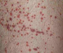When blood leaks under the skin or from where small blood vessels joins together; Purpura Types Causes Diagnosis And Treatment