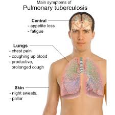 These symptoms may also be present in patients who experience several types of respiratory infections and other conditions. Study Tuberculosis Patients Have Higher Lung Cancer Risk