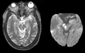 Image result for Midbrain