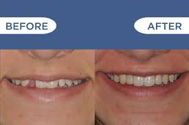 Maybe you would like to learn more about one of these? Dental Bridge Vs Implant How To Know What S Right For You