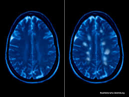 Die multiple sklerose ist eine chronisch entzündliche erkrankung des zentralen nervensystem (gehirn und rückenmark), die eine schädigung der markscheiden der nervenfasern verursacht. Ms Diagnose Was Zeigt Eine Mrt Untersuchung An