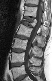 Injuries can range from relatively mild ligament and muscle strains, to fractures. Pathologic Fractures Radsource